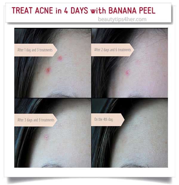 treat acne in 4 days with banana-peel