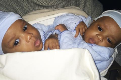 Boubacar et Hassane, les jumeaux siamois de Guinée