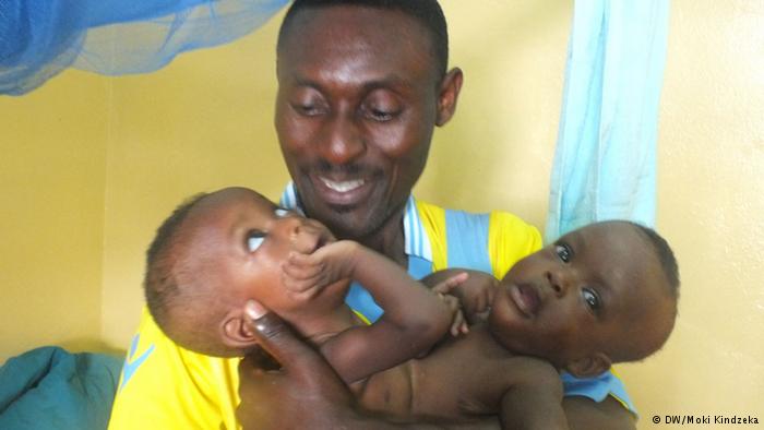 Cri du cœur d’un père, Julius Banla Ndi, pour sauver ces bébés siamois